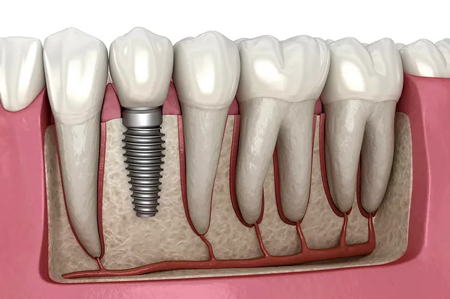 photo of dental implant